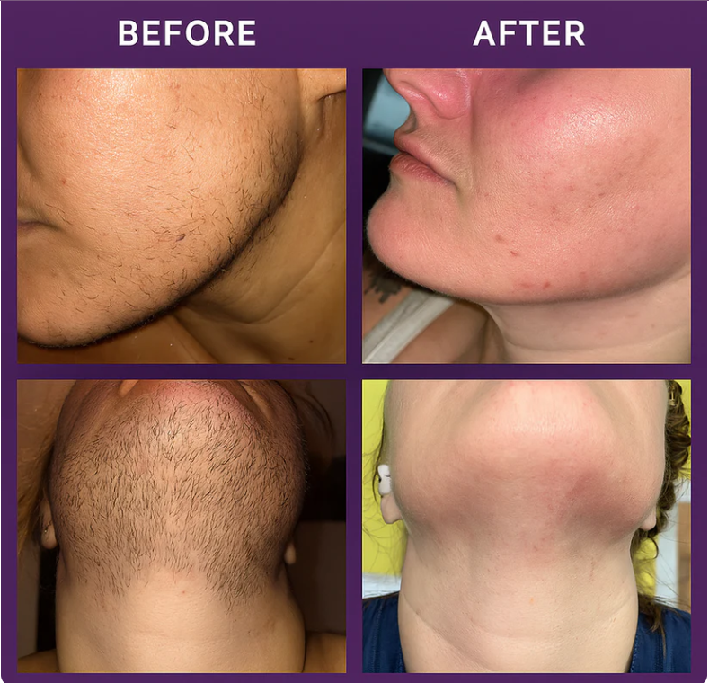 Zenova Facial hair removal cream